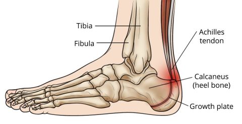 Sever’s Disease - Macquarie Physiotherapy