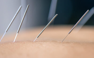 Understanding What Dry Needling Feels Like